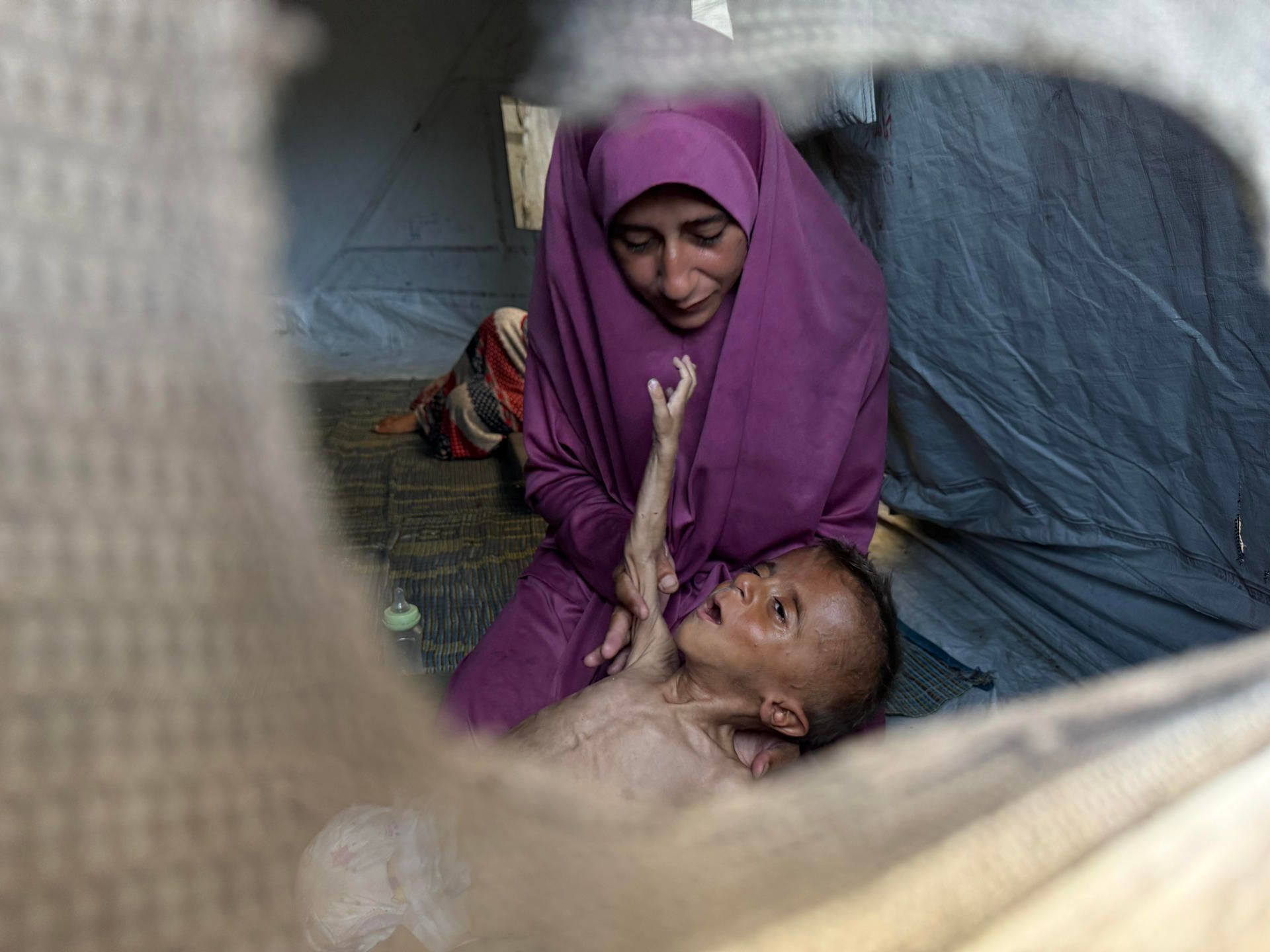 Desnutrición en Gaza: mueren cinco, un bebe y 2 niños en 24 horas
