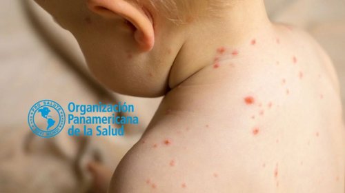 OPS emite alerta epidemiológica por sarampión en América