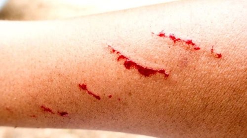 Muere adolescente en Zacatecas bajo sospecha de rabia humana
