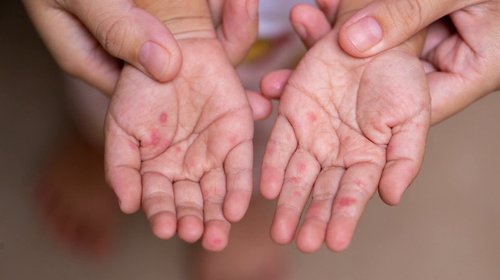 Contienen brote de virus mano, pie y boca en escuelas de Saltillo