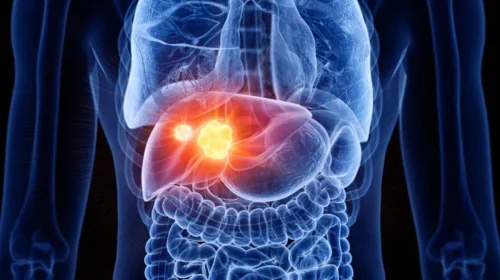 Casos de cáncer de hígado se duplicarán en 2050, según The Lancet