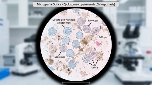 ¿Qué es la ciclosporiasis o 'diarrea explosiva' y cómo se trata?