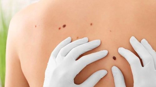Cofepris aprueba vacuna innovadora contra cáncer de piel