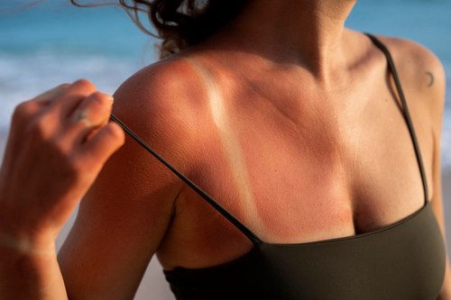 Protege tu piel: Conoce las enfermedades causadas por el sol