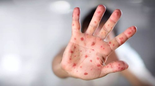 México detecta casos de sarampión procedentes de Europa