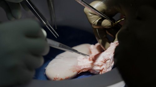 Trasplantan riñón de cerdo a hombre con muerte cerebral