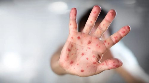 Suman 32 muertes y más de 11 mil casos por sarampión en México