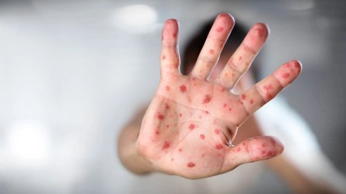México suma 28 muertes por sarampión y casi 9 mil casos