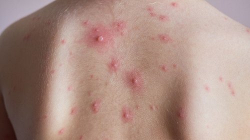 Descartan casos de sarampión en Reynosa tras evaluación clínica